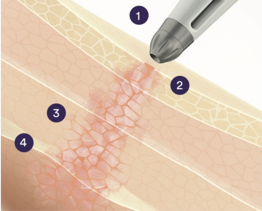 Dermadrop-hoidon vaiheet